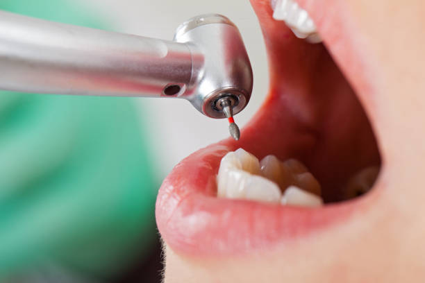 Best Emergency Treatment for Dental Infections or Abscesses in North Miami, FL